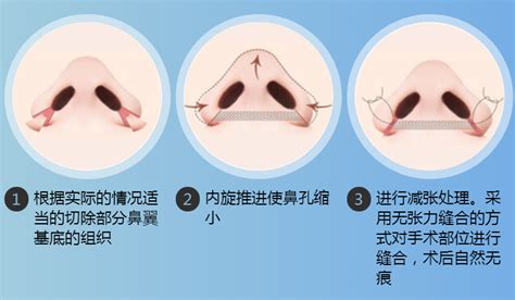 鼻頭大原因|鼻翼肥大：症狀、病因及如何治療